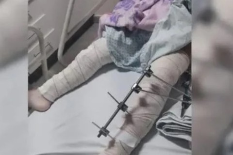 Hospital de Trauma de CG afasta médicos após realizarem cirurgia em perna errada de criança